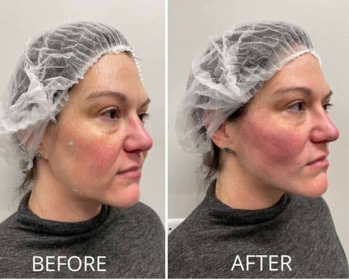 pdo thread lift atlanta, image of female patients’ before and after pictures showing the difference between their faces before and after pdo thread treatment.