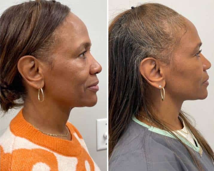 pdo thread lift atlanta, image of a female patient receiving pdo thread treatment on the left side of her face.