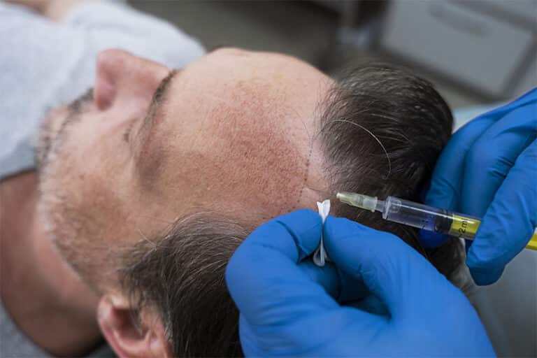 platelet-rich-plasma-injections-for-effectively-treating-hair-loss