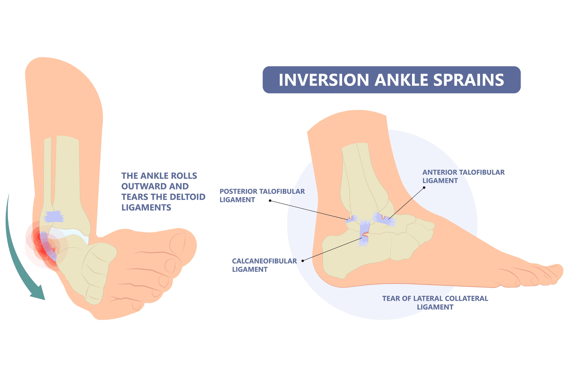Sprained ankle healing time diagram, demonstrating the anatomy of an inversion ankle sprain by identifying lateral ankle ligaments and showing the outward rolling motion of this type of sprain.