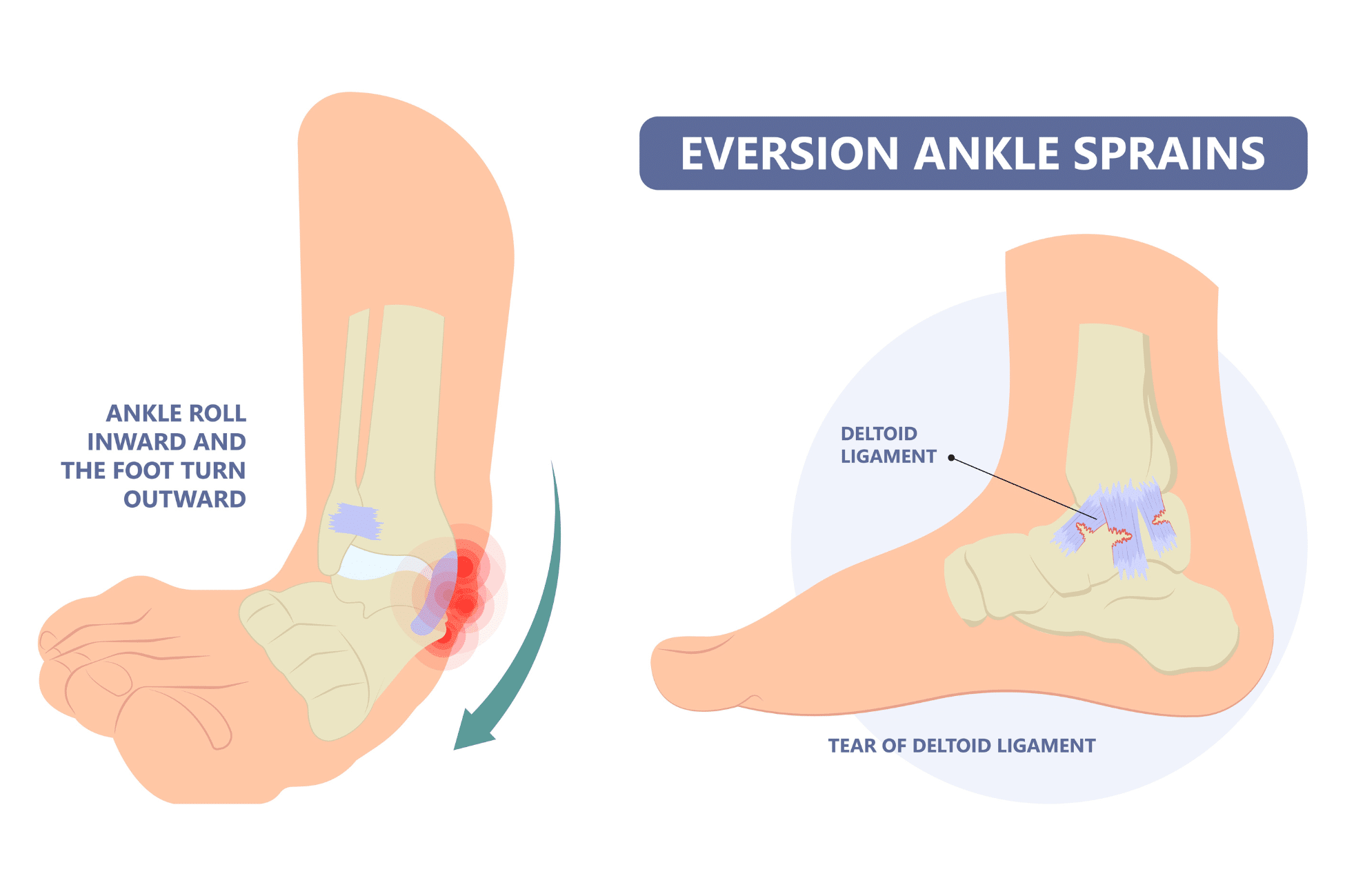 Sprained ankle healing time diagram, demonstrating the anatomy of an eversion ankle sprain by identifying the deltoid ligament and showing the inward rolling motion of this type of sprain.