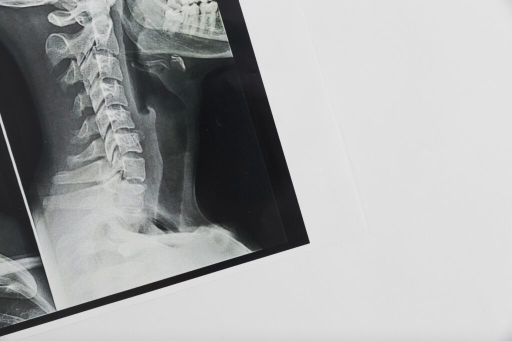Cervical instability; image of an x-ray image showing the side view of a cervical spine.