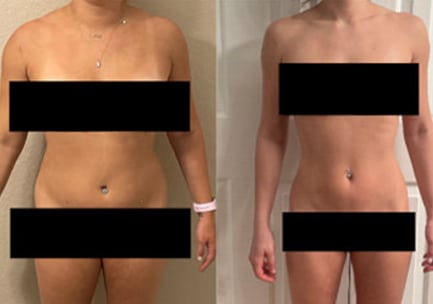 semaglutide before and after pictures, image of Patient B: a woman standing, facing the camera, her previous body shown on the left and her current body on the right.