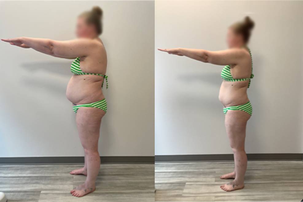 semaglutide before and after pictures, image of Patient A: a woman standing, facing away from the camera, wearing a green and white stripe bikini, her previous body shown on the left and her current body on the right.