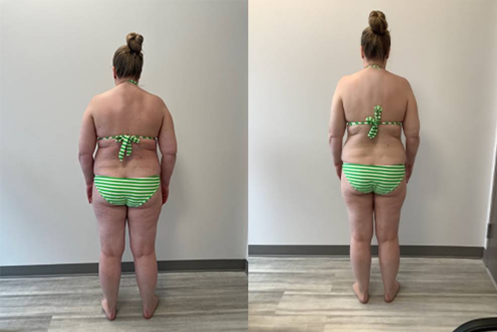 semaglutide before and after pictures, image of Patient A: a woman standing, facing away from the camera, wearing a green and white stripe bikini, her previous body shown on the left and her current body on the right.