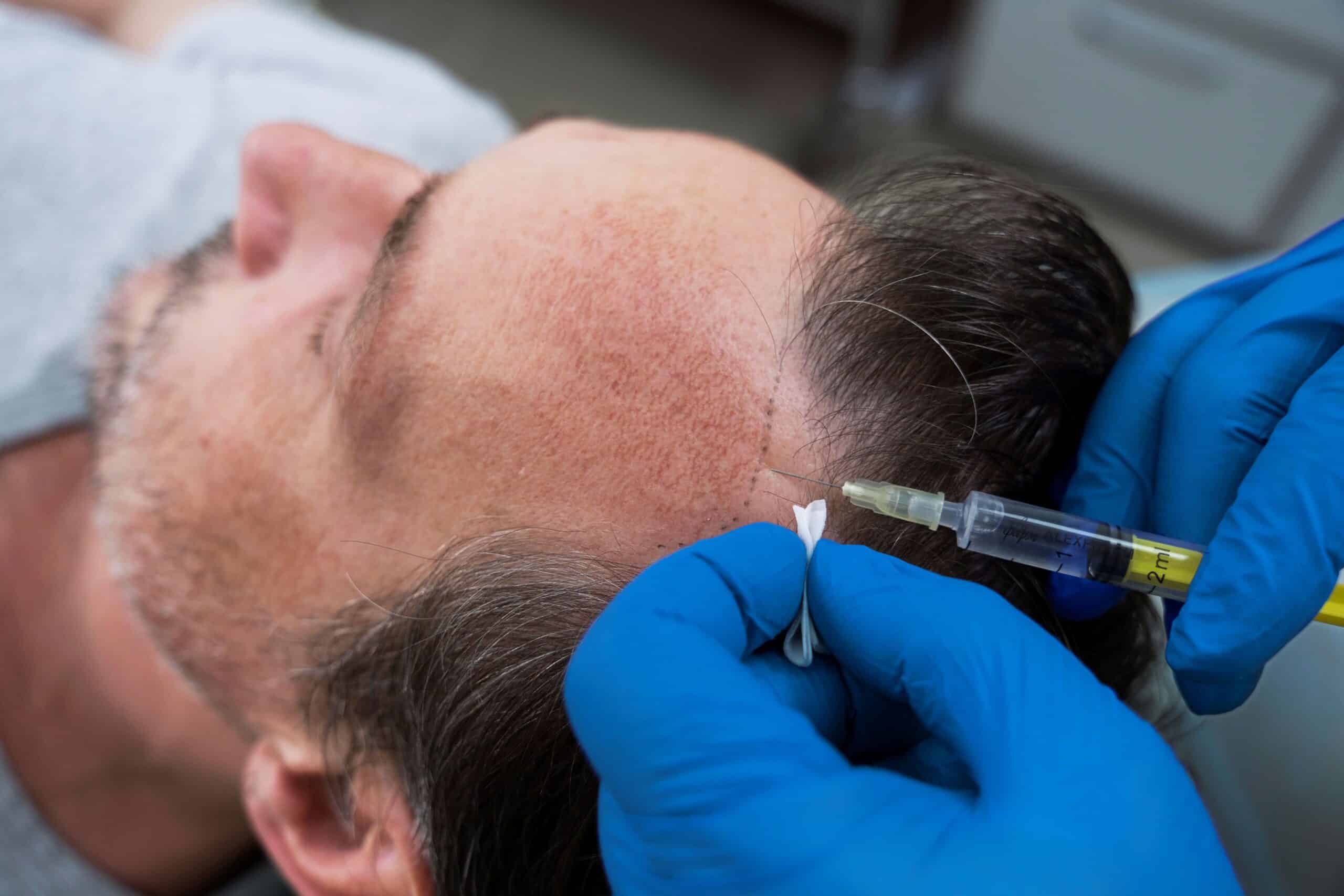 PRP hair treatment, Image of a doctor inserting an injection into a male patient’s hairline.