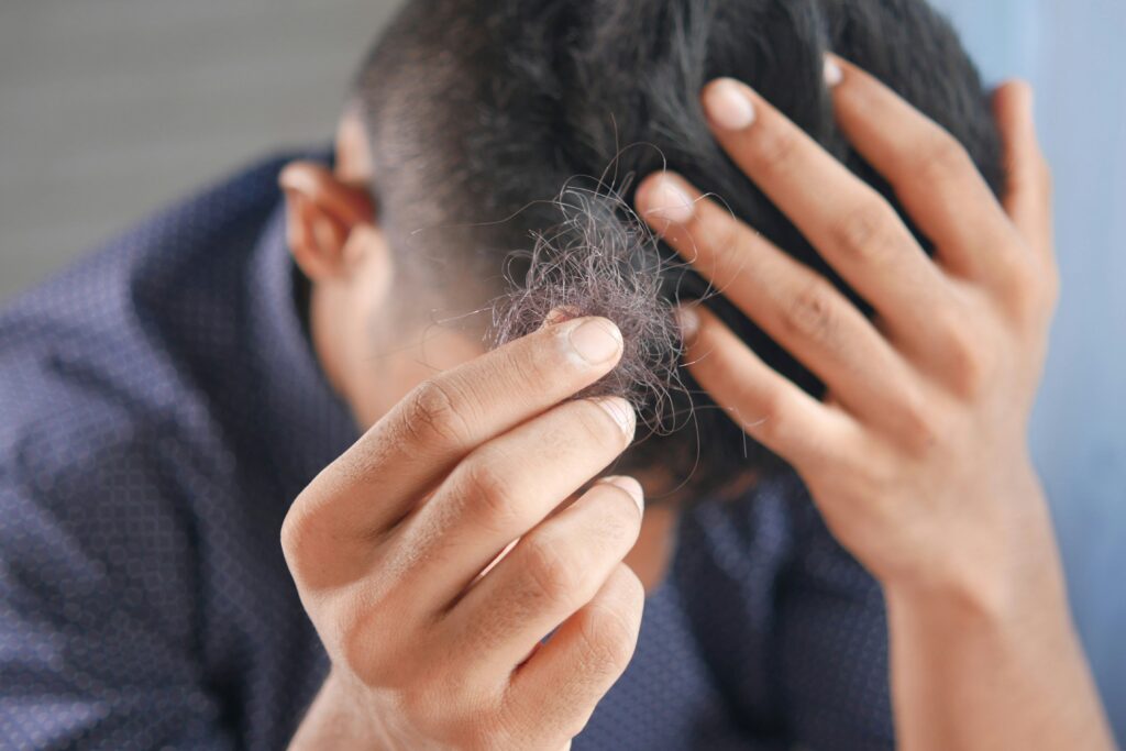 PRP hair treatment, Image of a man with his left hand on his head and holding up fallen-out hair in his right hand.