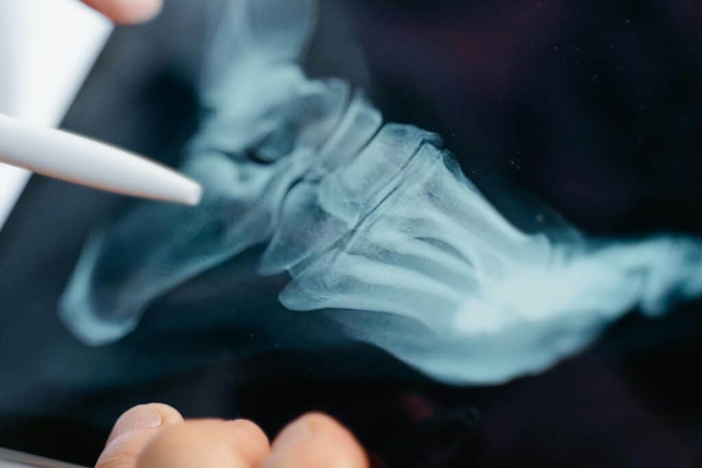 Orthopedic stem cell therapy, image of a foot x-ray with a pen pointing at it.