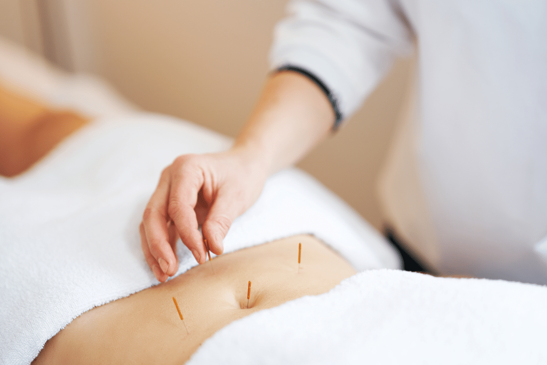Can Adhesions Cause Back Pain, image of a health practitioner inserting acupuncture needles in a woman patient’s stomach.